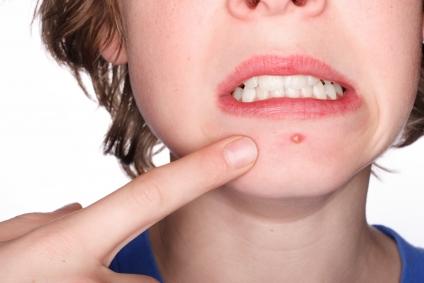 Acne: causas e tratamento