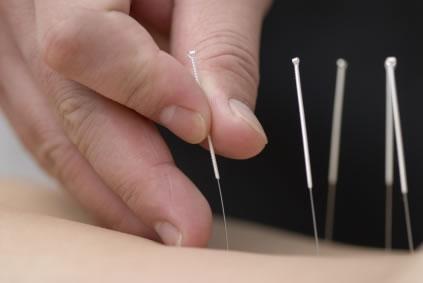 Acupunctura Na Saúde