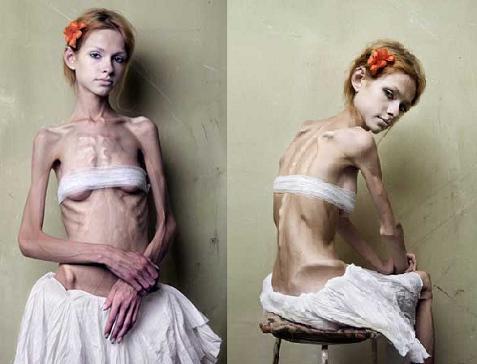 Anorexia Nervosa