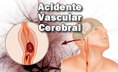 AVC - Acidente Vascular Cerebral