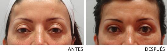 Blefoplastia - Uma Alternativa