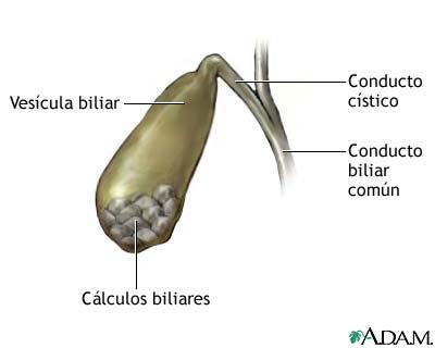 Càlculos biliares