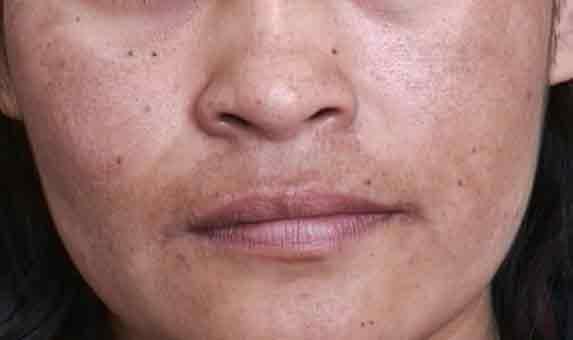 Como evitar manchas no rosto