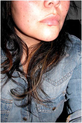 Herpes Labial Herpes Labial