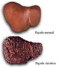 O que é cirrose e quais suas causas?