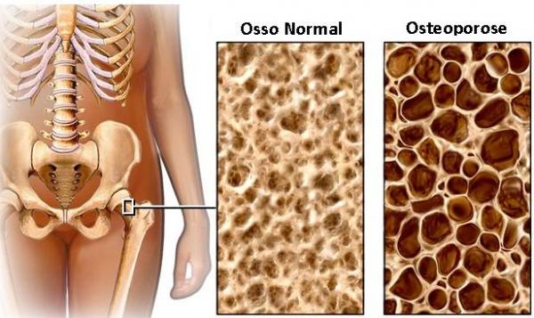 Osteoporose e Prevenção de Quedas