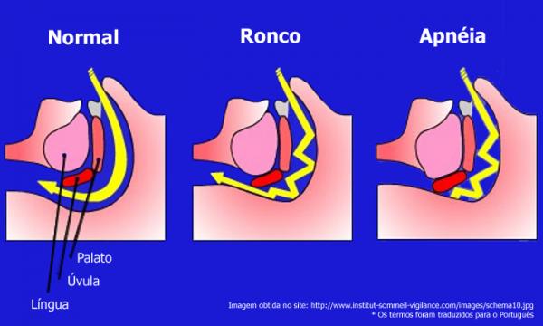 Síndrome de Apneia do Sono