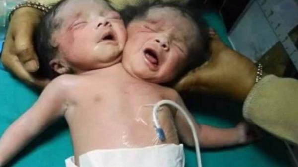 Bebês Que Nasceram Com Duas Cabeças