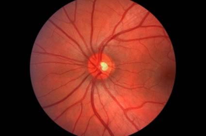 Conheça a retinopatia