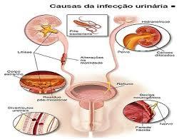 O que é infecção urinária e suas causas