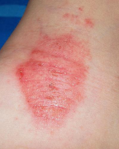 Tratamentos para eczemas e dermatoses
